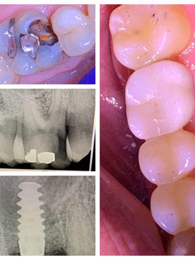 All On Four Dental Implant