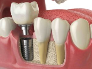 Dental Implant Frisco TX
