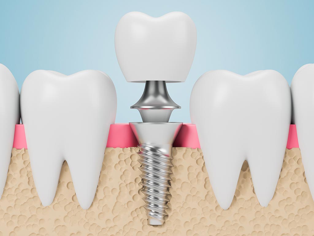 Dental Implant Crown