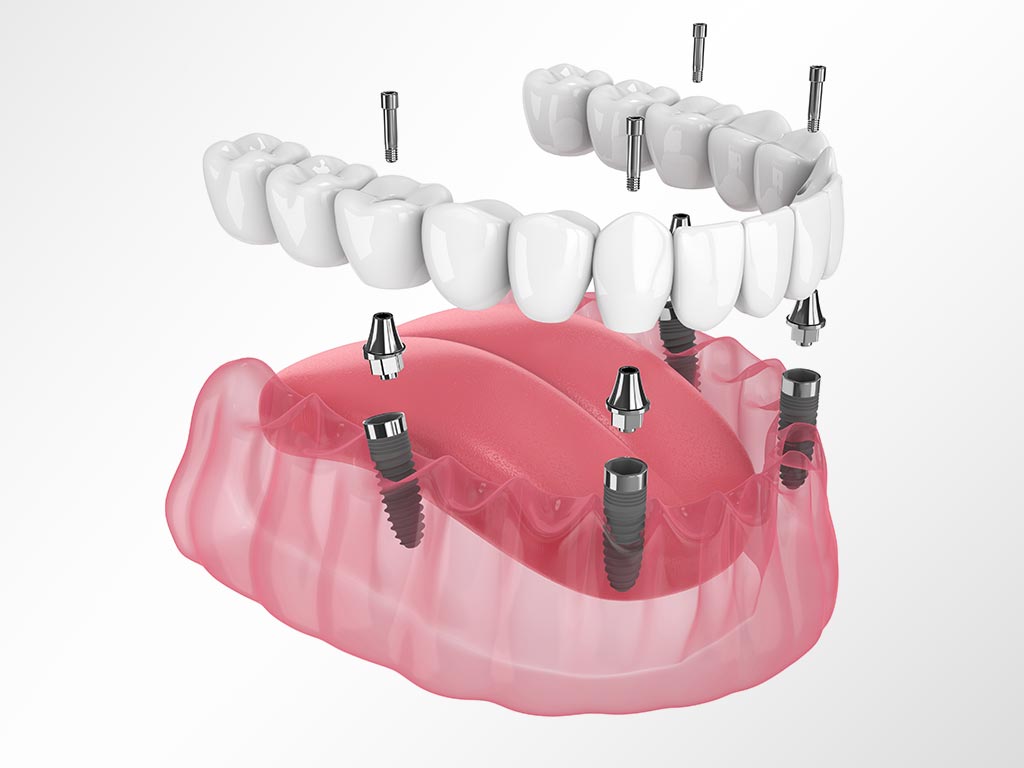 Supported Dentures